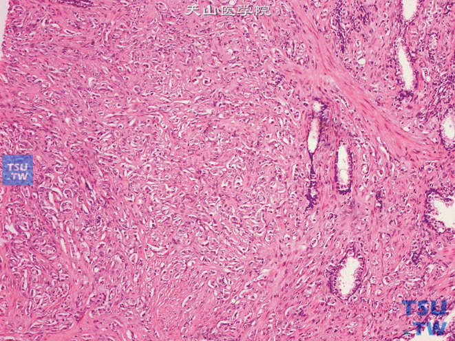 前列腺腺癌的形态学特点，细胞形成实性片状、实性条索或呈单个细胞浸润于间质中