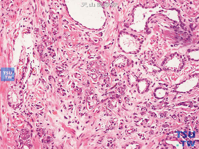 前列腺腺癌的形态学特点，癌细胞三五成群，细胞具明显核仁，腺腔结构几乎完全消失，仅偶尔可见腺腔