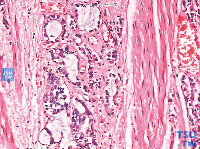 前列腺腺癌的形态学特点，示分泌黏液的前列腺腺癌