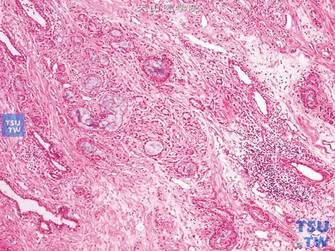 前列腺腺癌的形态学特点，可见蓝染黏液性分泌物