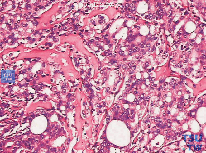 前列腺腺癌的形态学特点，可见胶原化