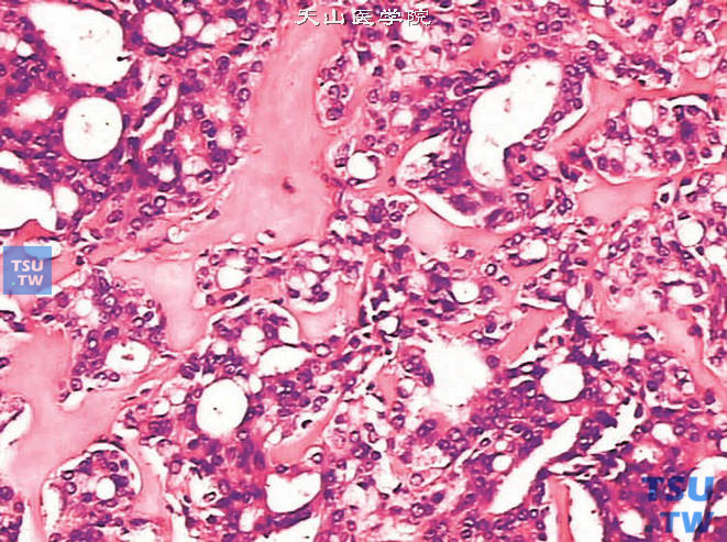 前列腺腺癌的形态学特点，可见胶原化，上图高倍