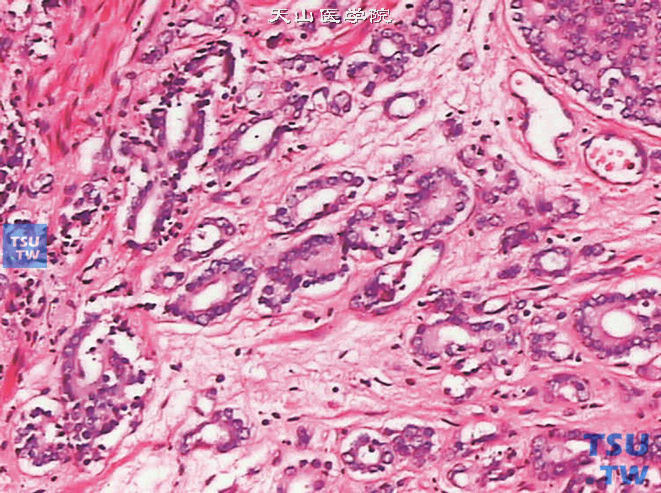 前列腺腺癌的形态学特点，可见结缔组织生成