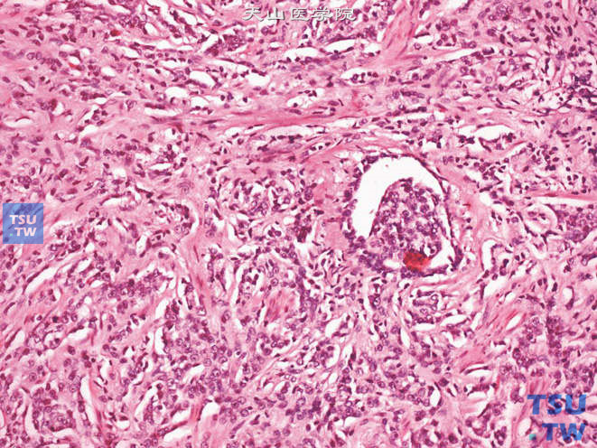 前列腺癌的肾小球样结构