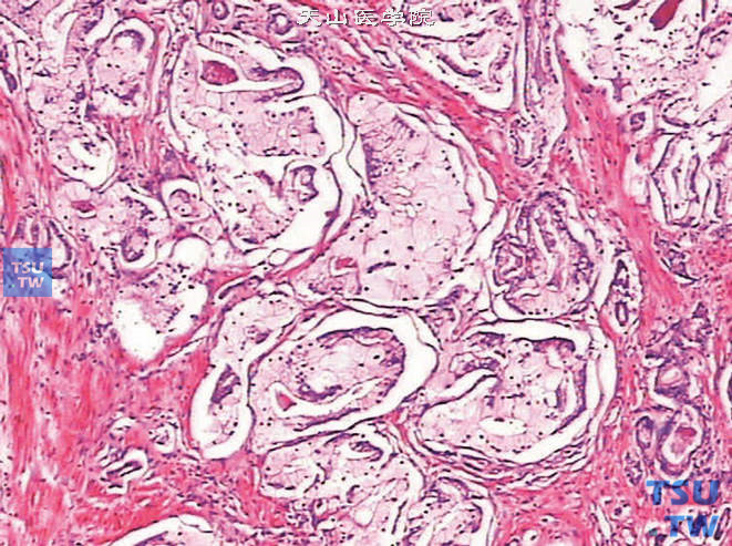 前列腺腺癌，泡沫状腺体型，细胞具丰富的泡沫状胞质，核质比很小