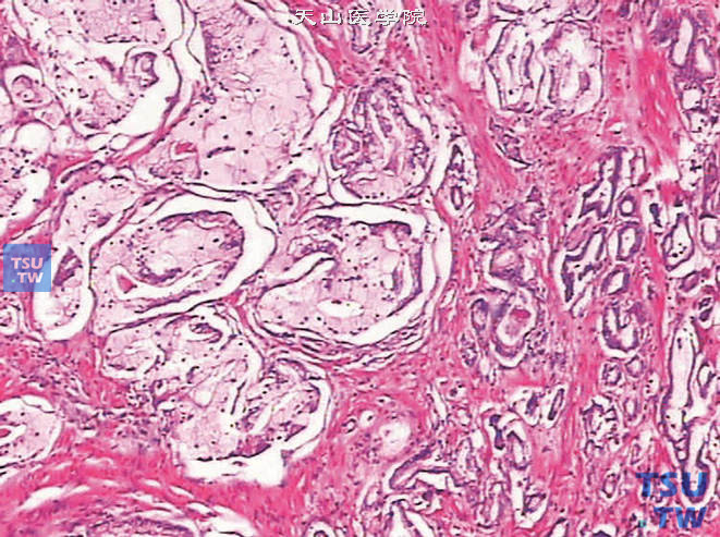 前列腺腺癌，泡沫状腺体型（左侧）伴经典型（右侧）