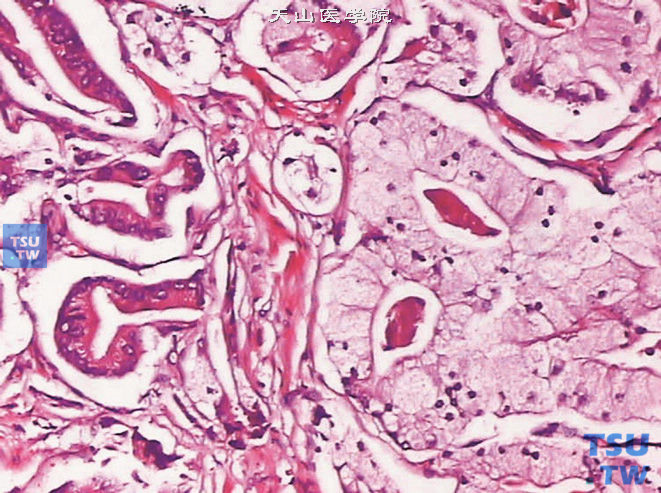 前列腺腺癌，泡沫状腺体型（右侧）伴经典型（左侧）（高倍）
