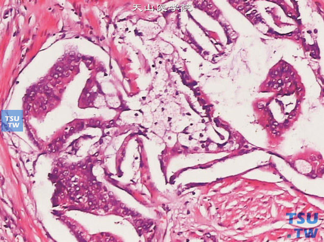 前列腺腺癌，泡沫状腺体型伴黏液型