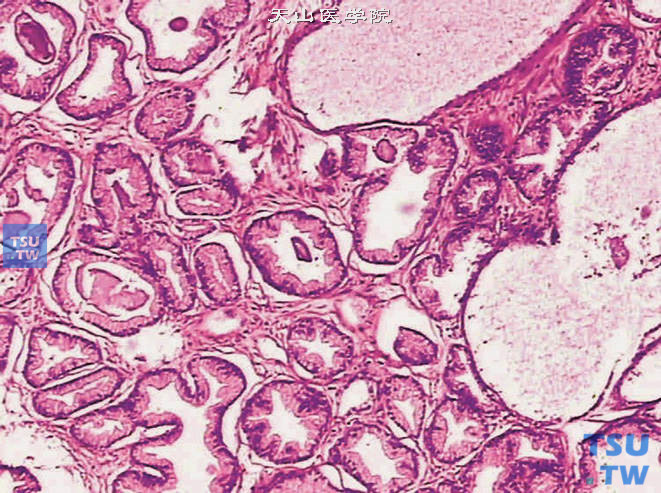 前列腺腺癌，假增生型。示腺体较大，排列拥挤，部分腔面边缘平坦。胞质丰富