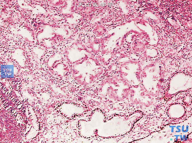 前列腺腺癌，假增生型。免疫组化：P63（-）