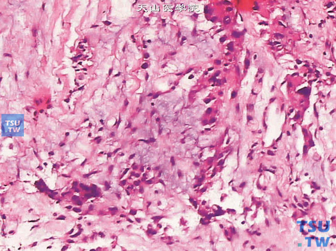 前列腺腺癌，胶样型，示细胞外黏液
