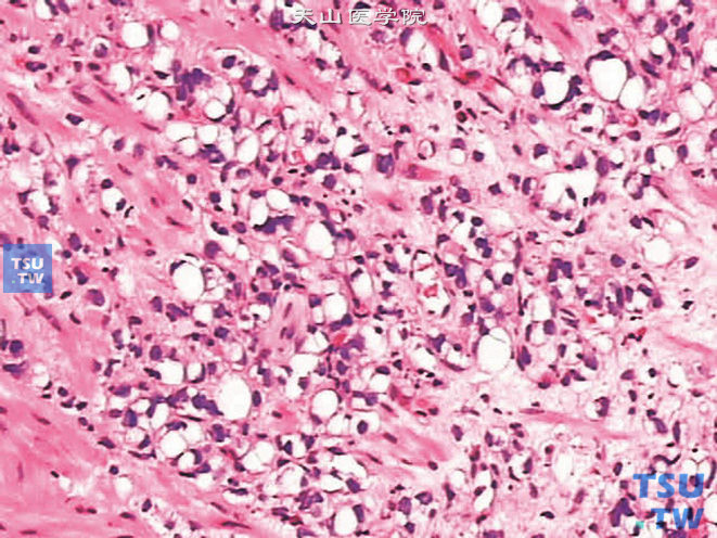 前列腺腺癌，印戒细胞型，瘤细胞具印戒细胞特点，但其空泡中不含胞质内黏蛋白。这些含空泡的细胞可出现于单个浸润的细胞、单个腺体或片状排列的细胞中