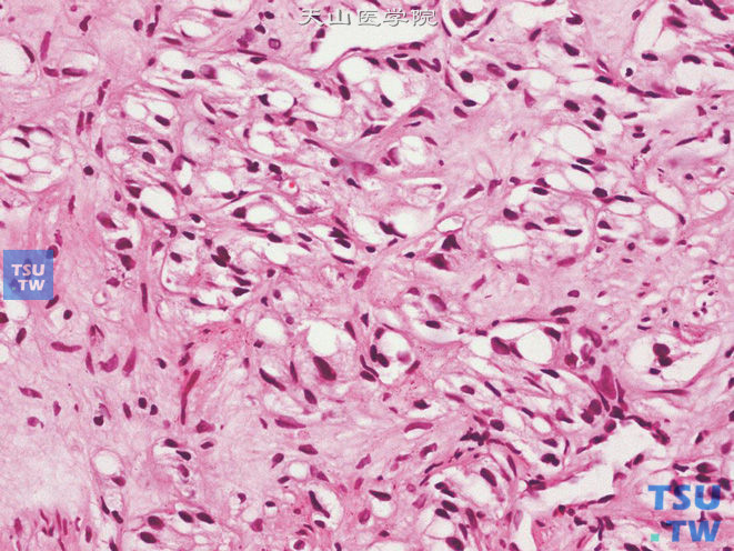 前列腺腺癌，印戒细胞型，瘤细胞具印戒细胞特点，但其空泡中不含胞质内黏蛋白