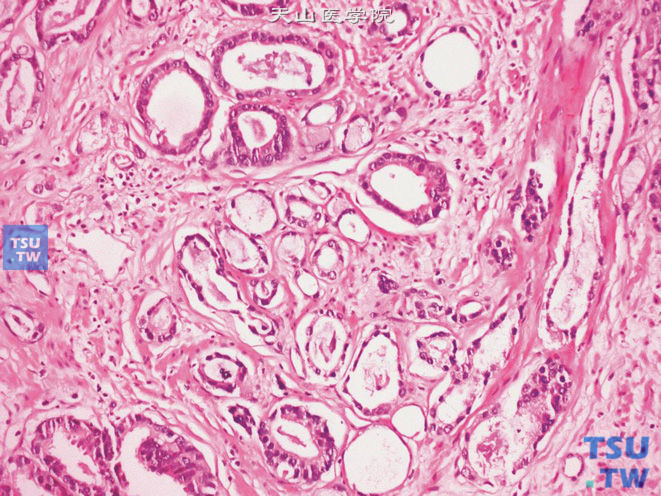 前列腺腺癌，萎缩型，胞质稀少，部分腺体呈微囊性结构。可见浸润性生长