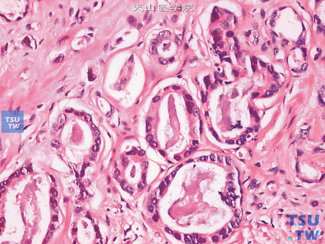 前列腺腺癌，萎缩型，上图高倍，示胞质稀少，可见显著的嗜酸性核仁