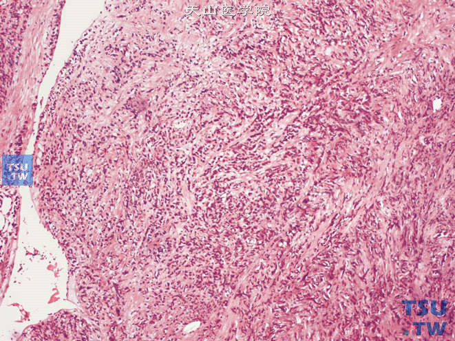 前列腺腺癌，肉瘤样型，其肉瘤样成分由非特异性恶性增生的梭形细胞构成