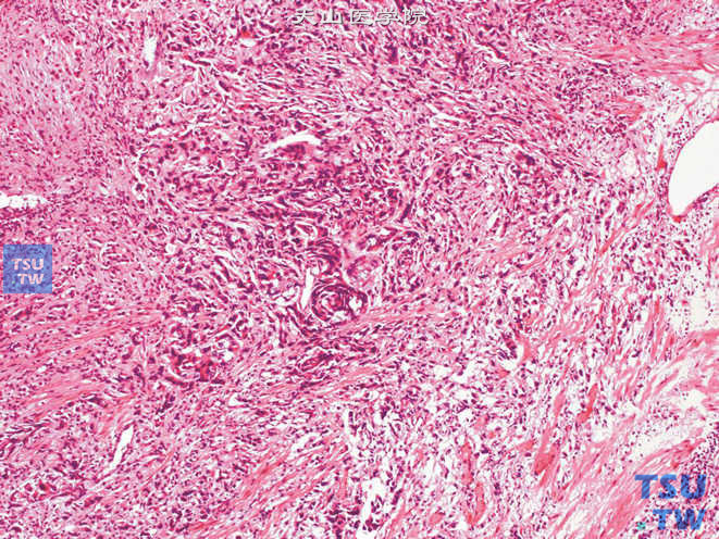 前列腺腺癌，肉瘤样型。可见非特异性恶性增生的梭形细胞