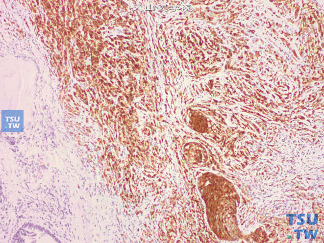 前列腺腺癌，部分细胞梭形，呈肉瘤样型表现。免疫组化：PSA（+）