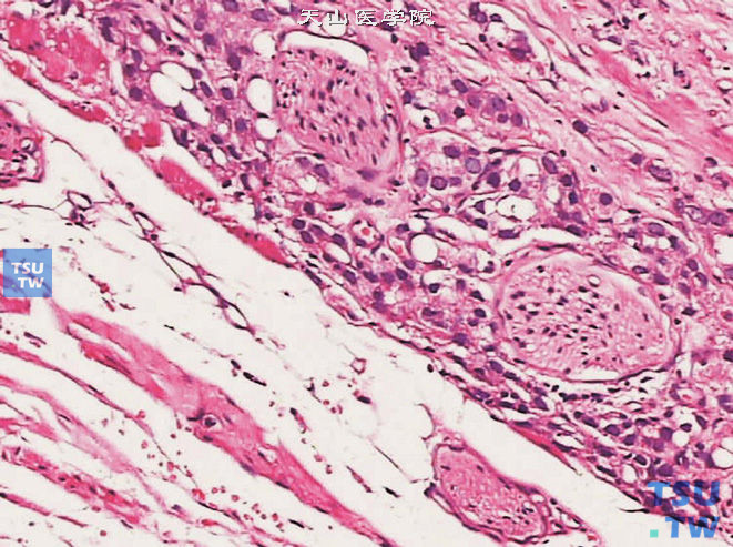 前列腺腺癌，示肿瘤沿神经侵出被膜
