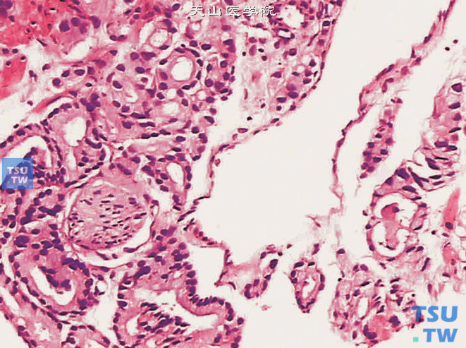 前列腺腺癌侵犯神经（横切面），可见癌组织围绕神经周围一周