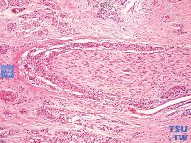 前列腺腺癌，示侵犯神经（纵切面）（上图高倍）
