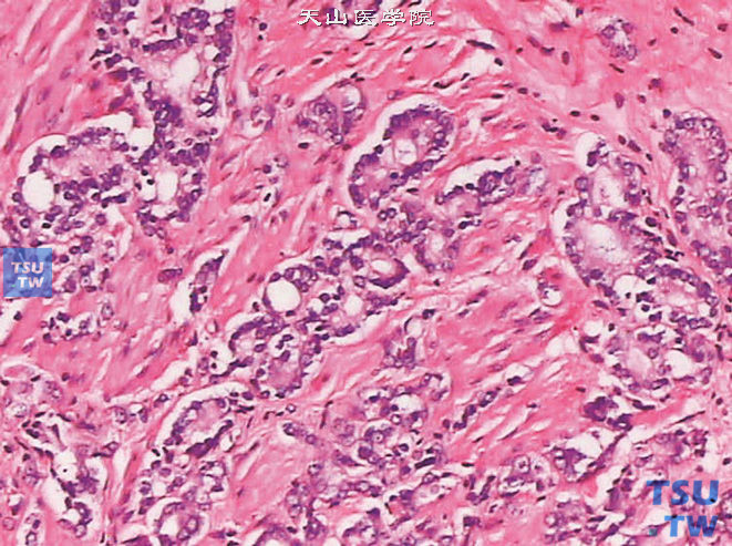 前列腺腺癌的形态学特点，示前列腺腺癌浸润平滑肌组织