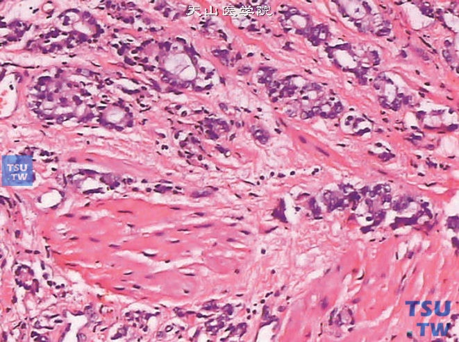 前列腺腺癌的形态学特点，示前列腺腺癌浸润平滑肌组织（上图高倍）