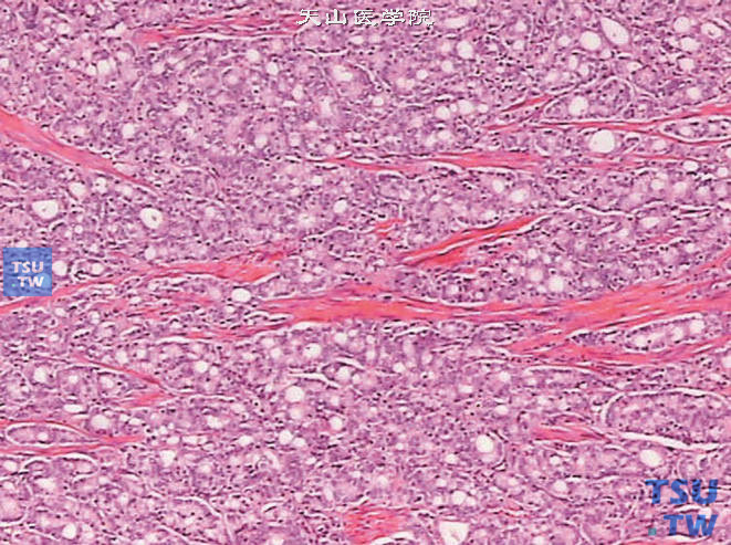 前列腺腺癌的形态学特点，示前列腺腺癌浸润平滑肌组织，可见断裂的平滑肌束