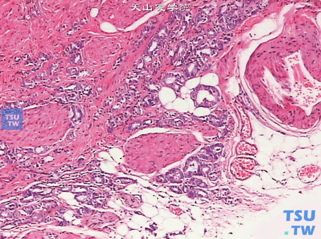 前列腺腺癌的形态学特点，前列腺腺癌突破被膜，侵犯脂肪组织