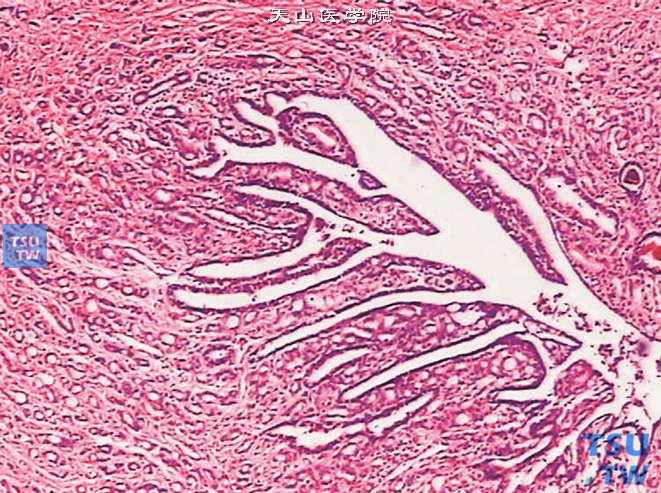 前列腺腺癌的形态学特点，示前列腺腺癌浸润至前列腺导管周围
