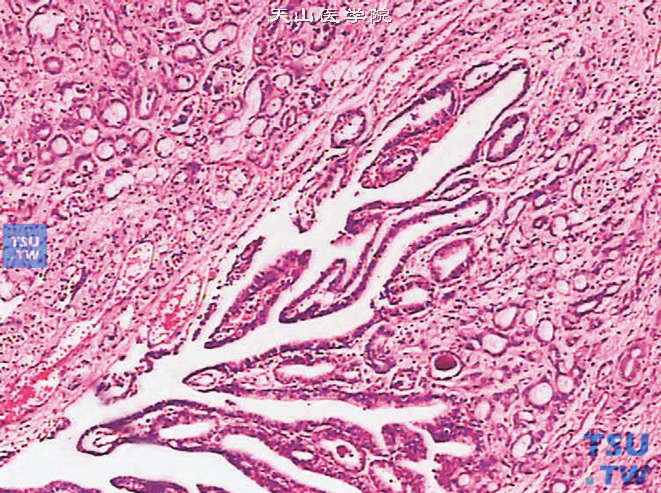 前列腺腺癌的形态学特点，示前列腺腺癌浸润至后尿道