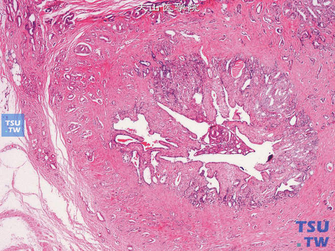 前列腺腺癌的形态学特点，示前列腺腺癌侵犯精囊腺达腺腔