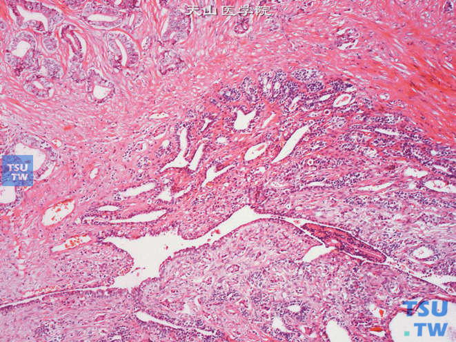 前列腺腺癌的形态学特点，示前列腺腺癌侵犯精囊腺，上图高倍