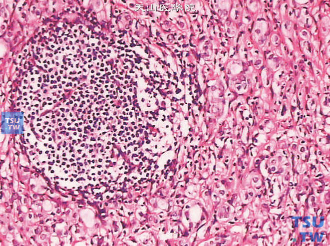 前列腺腺癌的形态学特点，前列腺腺癌闭孔淋巴结转移，上图高倍