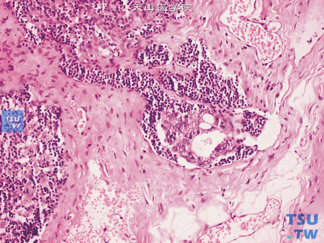前列腺腺癌微小淋巴结转移，pN1mi