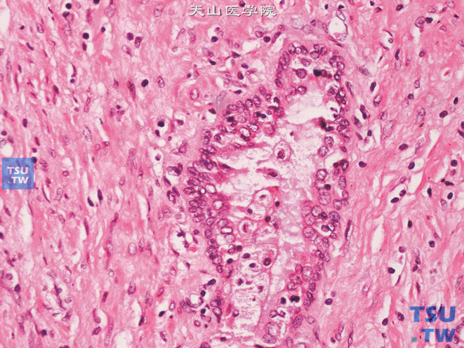 前列腺腺癌的形态学特点，前列腺癌抗雄激素治疗后，肿瘤细胞核固缩，很像具黄色瘤样胞质的泡沫细胞，脱落于腺腔中