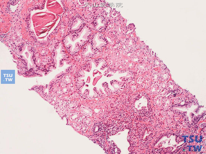 前列腺腺癌的形态学特点，前列腺穿刺标本中的前列腺腺癌，由癌性小腺泡构成，与其周围的正常腺体形成鲜明对比