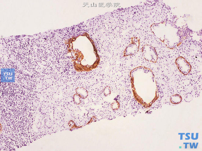 前列腺腺癌的形态学特点，前列腺穿刺标本中的前列腺腺癌，免疫组化：34βE12 （-）