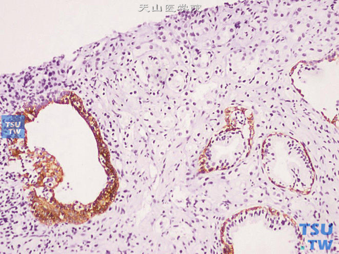 前列腺腺癌的形态学特点，前列腺穿刺标本中的前列腺腺癌，免疫组化：34βE12 （-），上图高倍