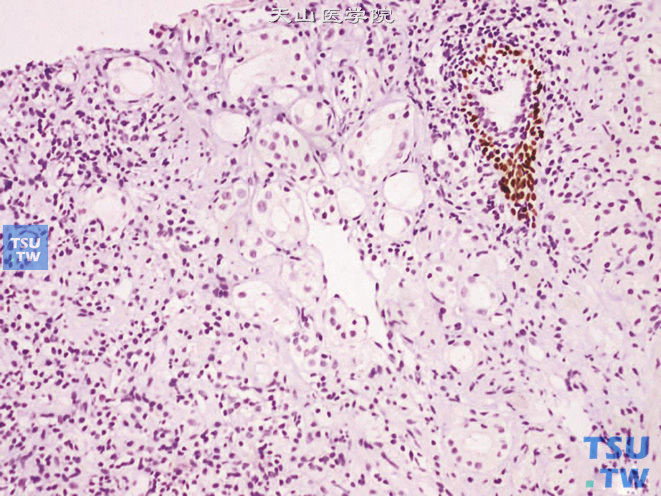 前列腺腺癌的形态学特点，前列腺穿刺标本中的前列腺腺癌，免疫组化：P63（-）