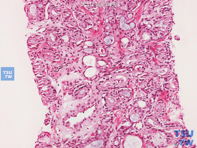 前列腺腺癌的形态学特点，前列腺腺泡腺癌（穿刺标本），腺腔内可见黏液分泌