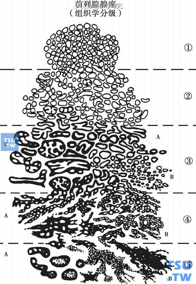 前列腺腺癌Gleason分级系统示意图