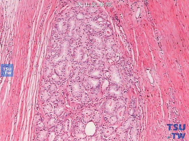 前列腺腺泡腺癌的Gleason分级系统