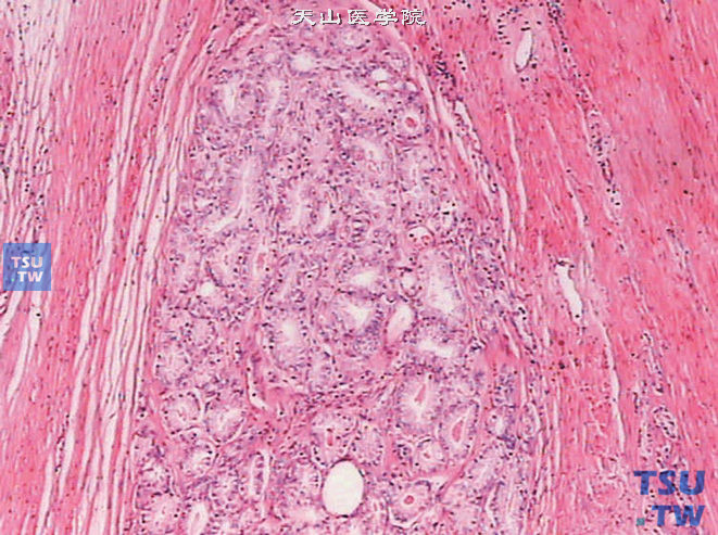 前列腺偶发癌，Gleason 1级。示癌性腺泡大小形状均一。细胞核较小。腺体背靠背密集排列
