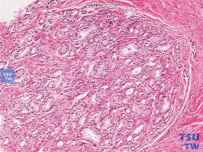 前列腺偶发癌，Gleason 1级。癌组织由密集的小腺体构成，腺体大小形态相似，癌巢边缘整齐