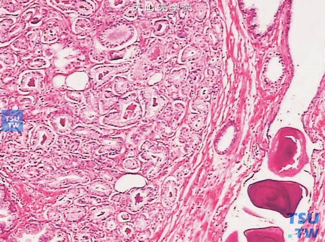前列腺偶发癌Gleason 1级，示癌巢边缘整齐，腺体排列密集