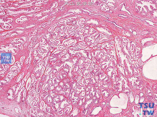 前列腺腺癌，Gleason 2级。肿瘤由圆形或卵圆形腺体构成，腺体之间在大小及形态上差异比Gleason 1级前列腺癌明显。癌结节边缘腺体散开，可见到肿瘤性腺体在周围非肿瘤性前列腺组织中有微小浸润