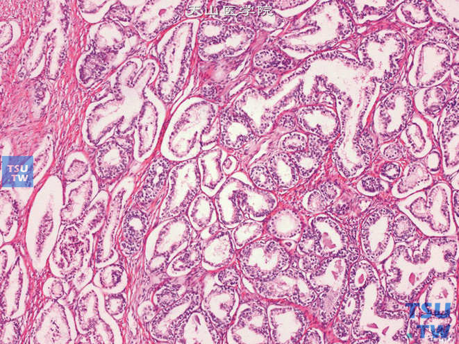 前列腺腺癌，Gleason 2级。上图高倍。示癌性腺体上皮为单层立方上皮