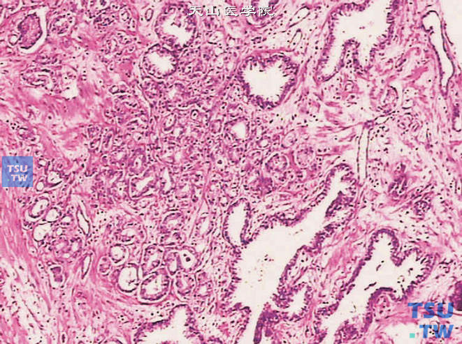 前列腺偶发癌，Gleason 2级。腺体排列较1级松散，边缘腺体散开，可见微小浸润