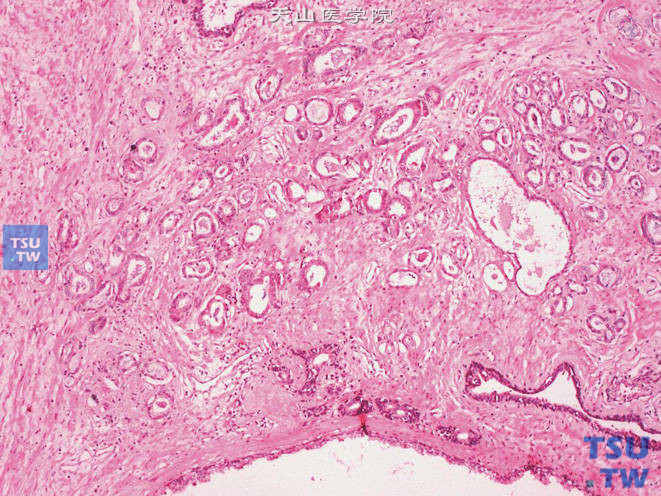 前列腺腺癌，Gleason 3级。腺体的多形性及分散度较2级明显